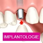 Implantologie